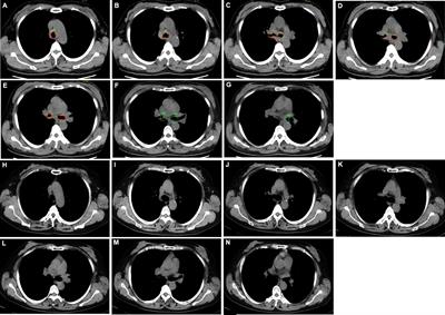 Stent loaded with radioactive Iodine-125 seeds for adenoid cystic carcinoma of central airway: A case report of innovative brachytherapy